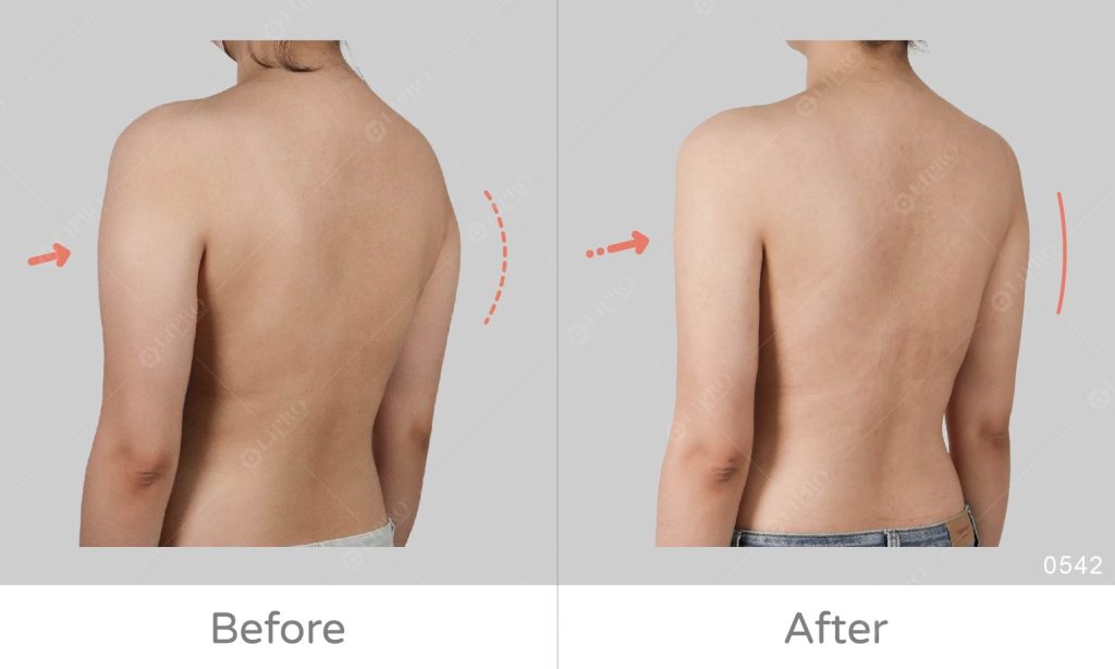 個案先天手臂脂肪較多集中在手臂三角肌及副乳的位置，未經過調整的手臂曲線讓背影有種虎背熊腰感