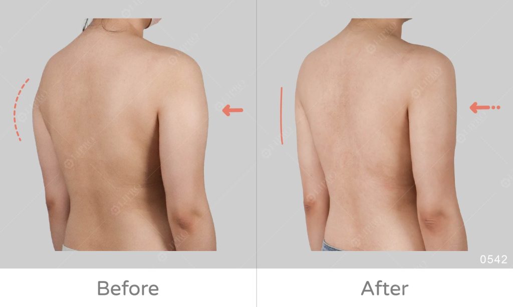 個案背影有種虎背熊腰感，經過顯微套管抽脂手臂曲線的調整，整體背影看起來更加精緻