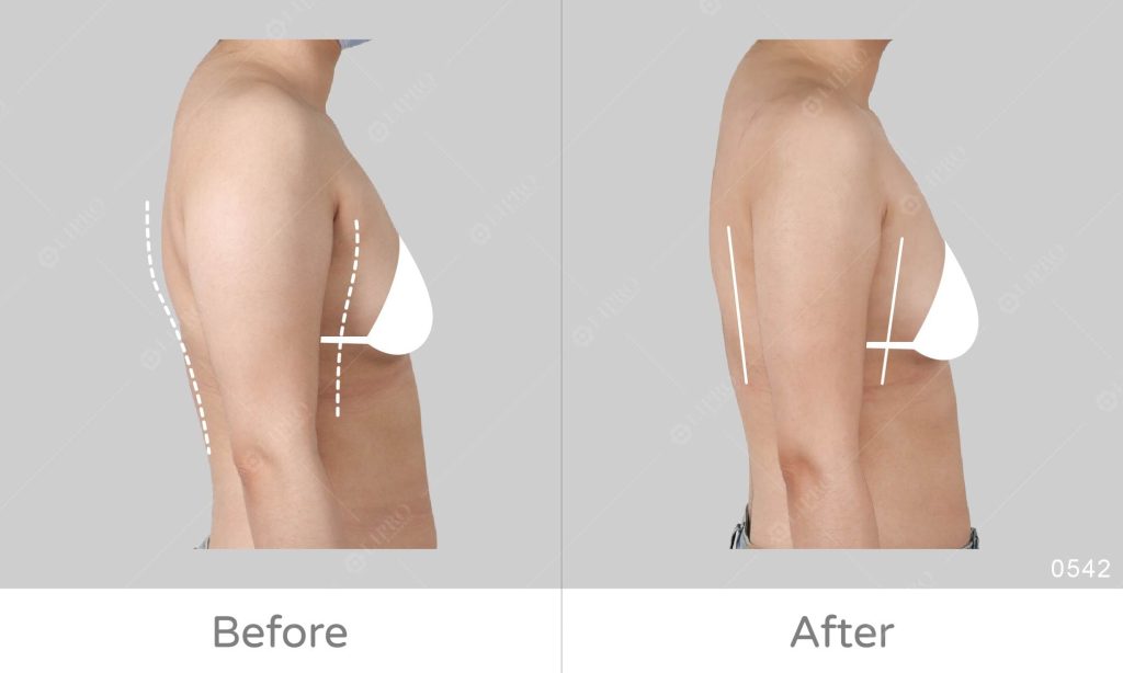 麗波永康精緻手臂抽脂案例分析：手臂精緻化，顯微套管抽脂不須穿塑身衣