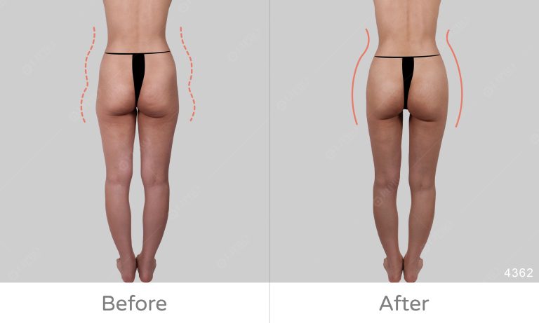 顯微套管抽脂臀部案例分享，背面成效展示圖