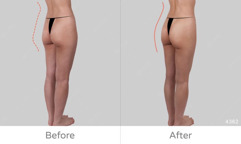 顯微套管抽脂臀部案例分享，側背面45度角成效展示圖