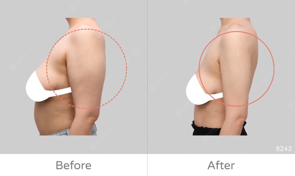 手臂外觀比較肥胖，尤其是手臂後側以及後副乳的部分，背影看起來顯壯