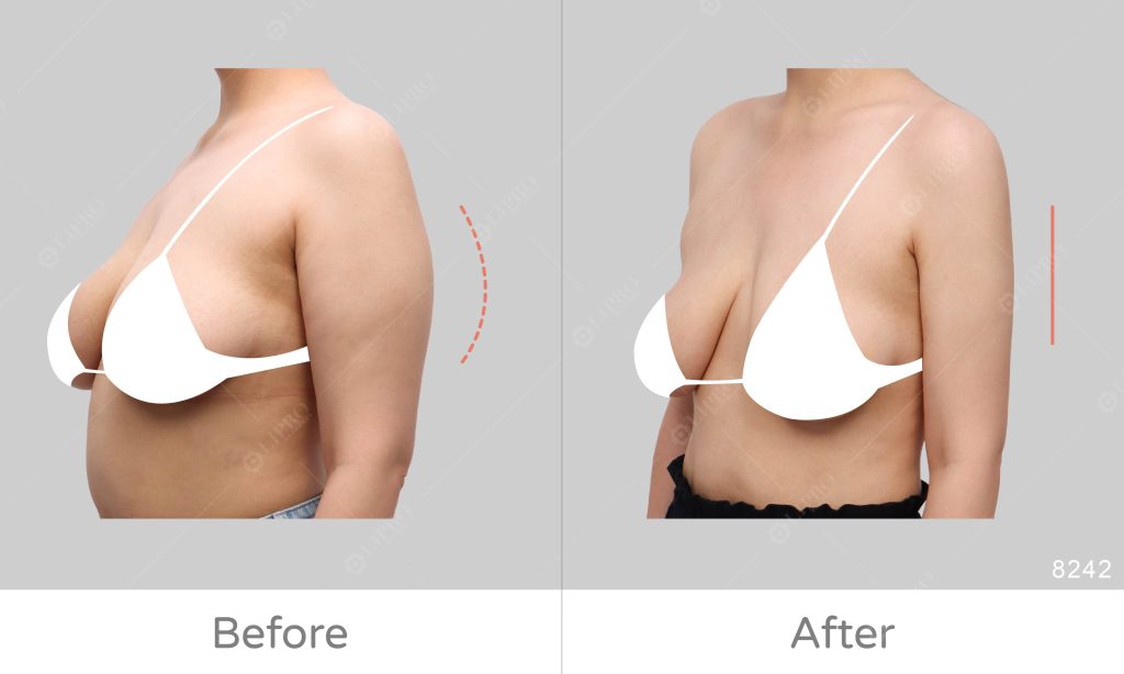 透過飲食和運動控制體重減少手臂部位脂肪堆積，決定接受顯微套管手臂抽脂手術