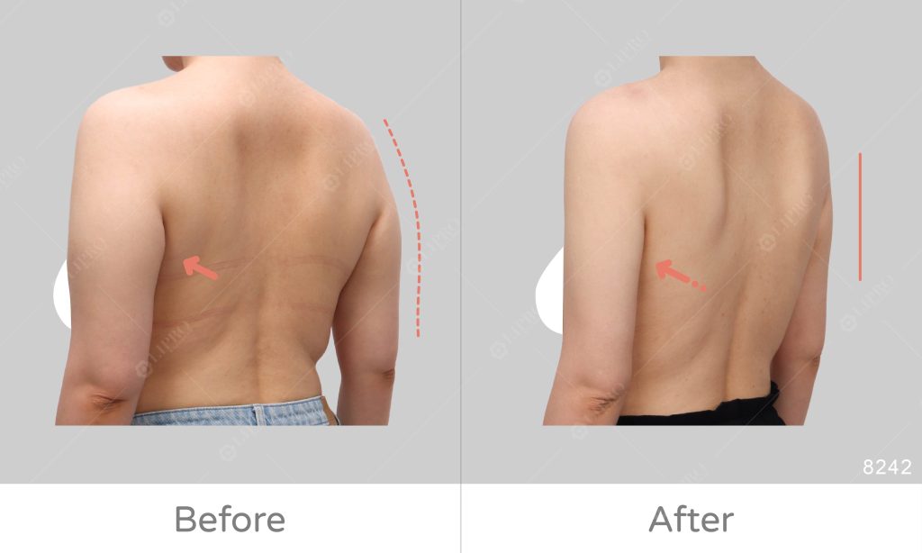 顯微套管抽脂手術修飾手臂與後背的曲線美感，改變虎背熊腰的感覺