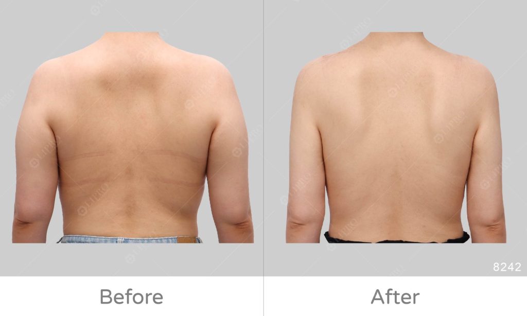 擺脫虎背熊腰感、精緻的手臂抽脂手術交給麗波永康專業抽脂醫美診所