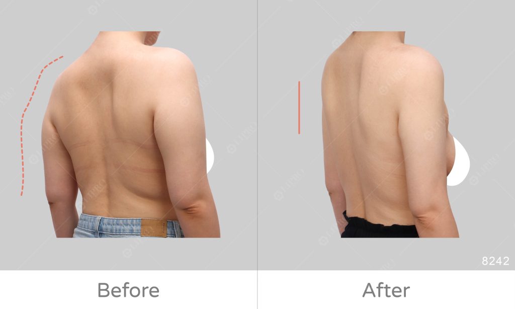 手臂抽脂成效展示、抽脂後擺脫背影顯狀的感覺