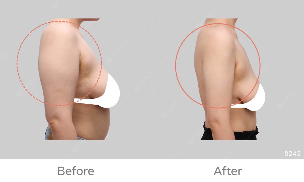顯微套管抽脂、手臂精緻抽脂手術前後對比示意圖