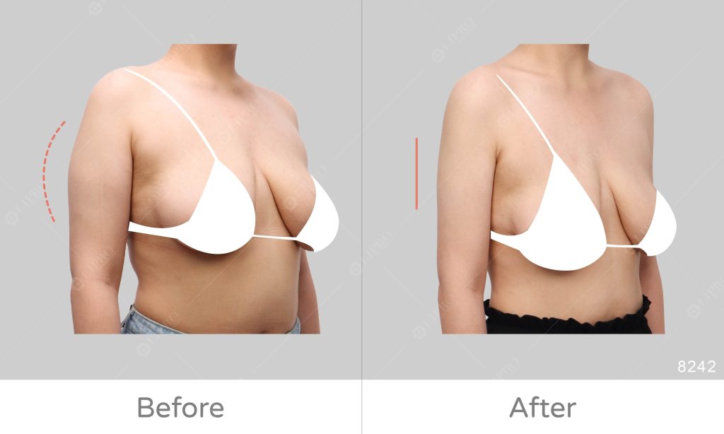 手臂抽脂個案案例分析：脂肪囤積在手臂後側、背影顯壯