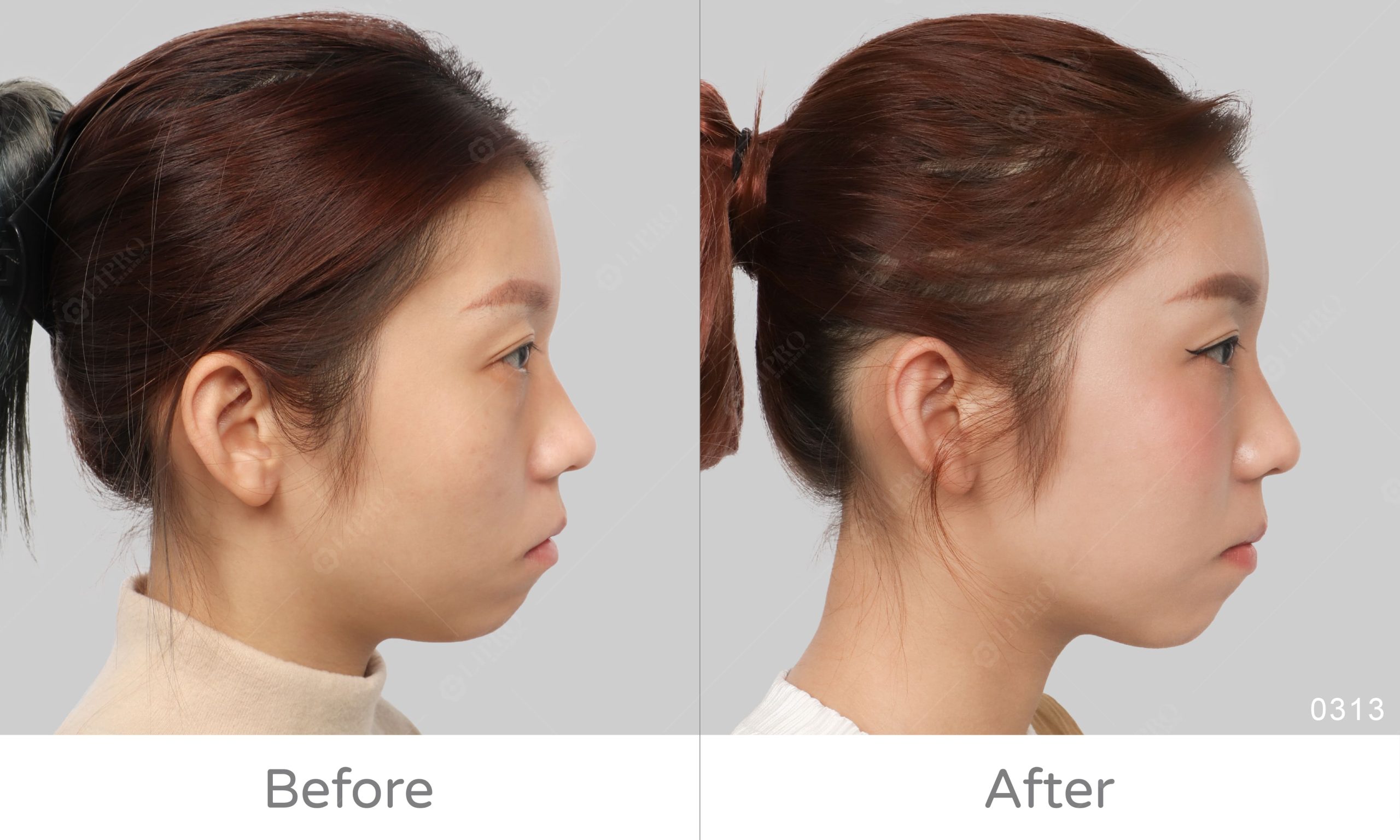 顯微套管精緻全臉補脂，臉部脂肪移植手術案例前後對比