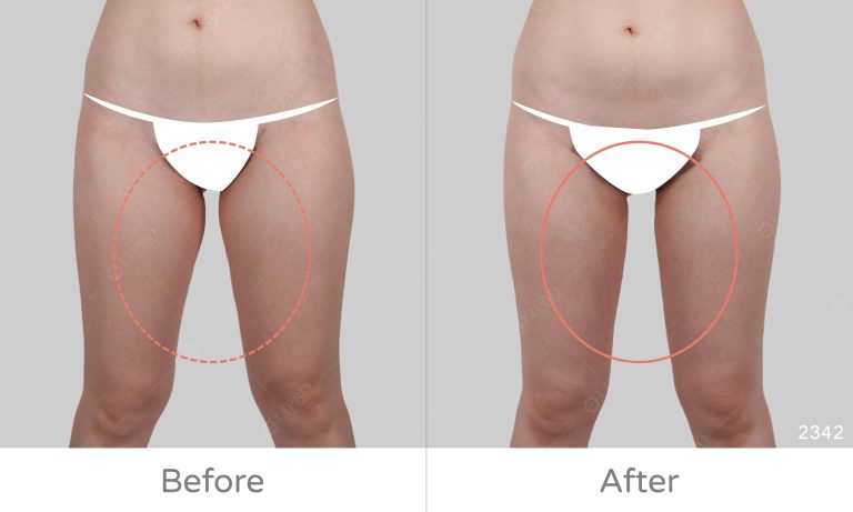 術後照護輕鬆、不須穿塑身衣的抽脂新選擇，麗波永康顯微套管抽脂術