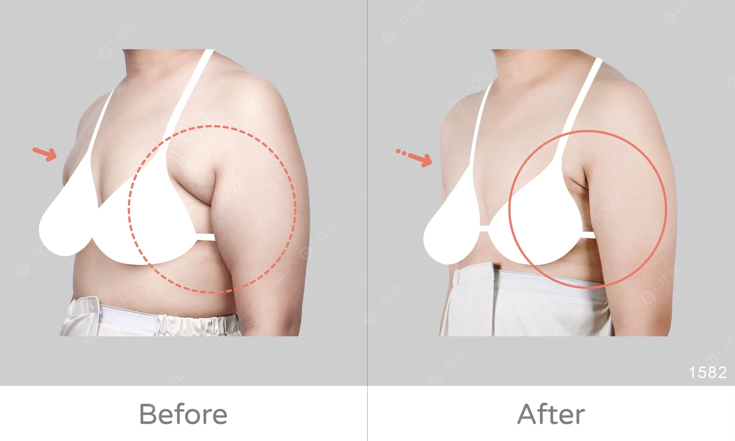 不需切皮不須穿塑身衣的副乳抽脂選擇，術後恢復快速的顯微套管抽脂手術