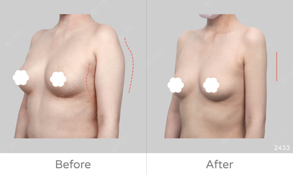 美中不足的手臂曲線，可經由顯微套管抽脂術精緻調整