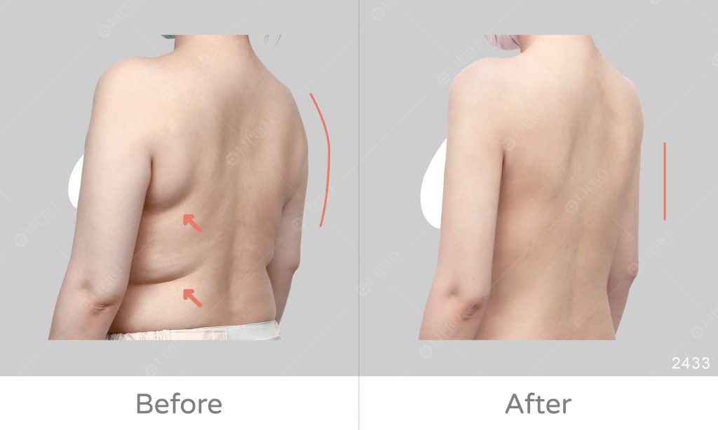 長期飲食和運動控制體重，但手臂卻始終無法減少脂肪堆積