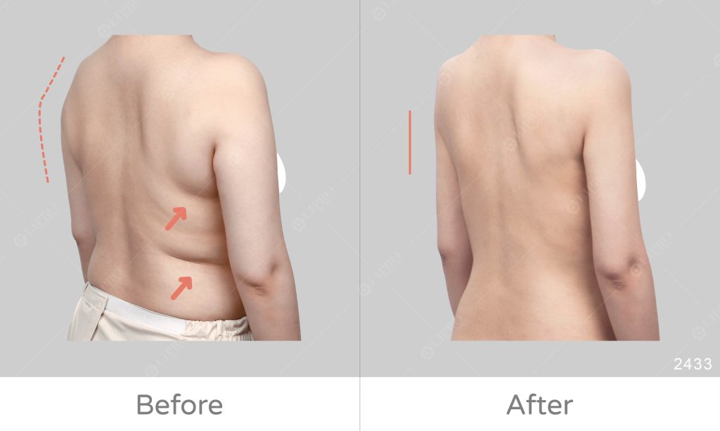 三角肌顯壯，脂肪囤積在手臂內側、後側延伸至後副乳，背部脂肪堆積明顯