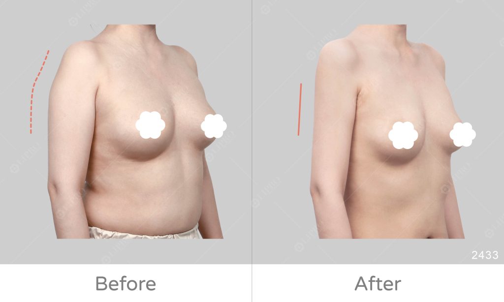 脂肪脂肪囤積在三角肌上方以及手臂內側、後側，手臂抽脂手術搭配減重達到理想的效果