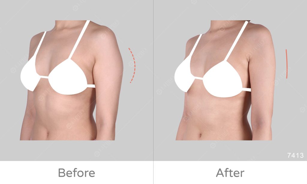 此案例整體手臂纖細，但手臂精緻度稍嫌不足，透過顯微套管抽脂調整背影、側面精緻度