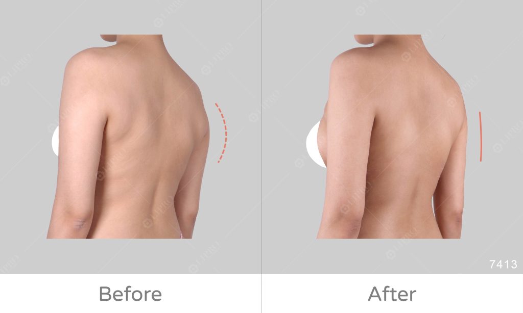 手臂後側三角肌位置以及後副乳的部分，背影看起來顯壯