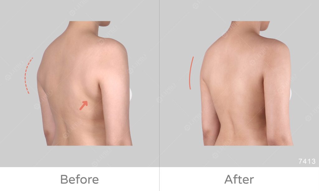 背影顯狀、總是要挑衣服遮手臂感到困擾，因此決定接受手臂抽脂手術改善手臂曲線美感