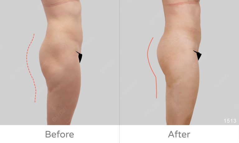 透過顯微套管抽脂技術可以精緻調整臀部比例