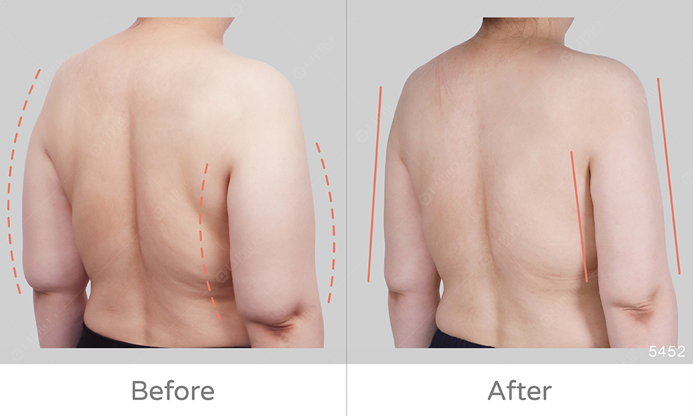 手臂精緻抽脂手術、前後副乳、腋窩一併處理，術後自信展示手臂線條