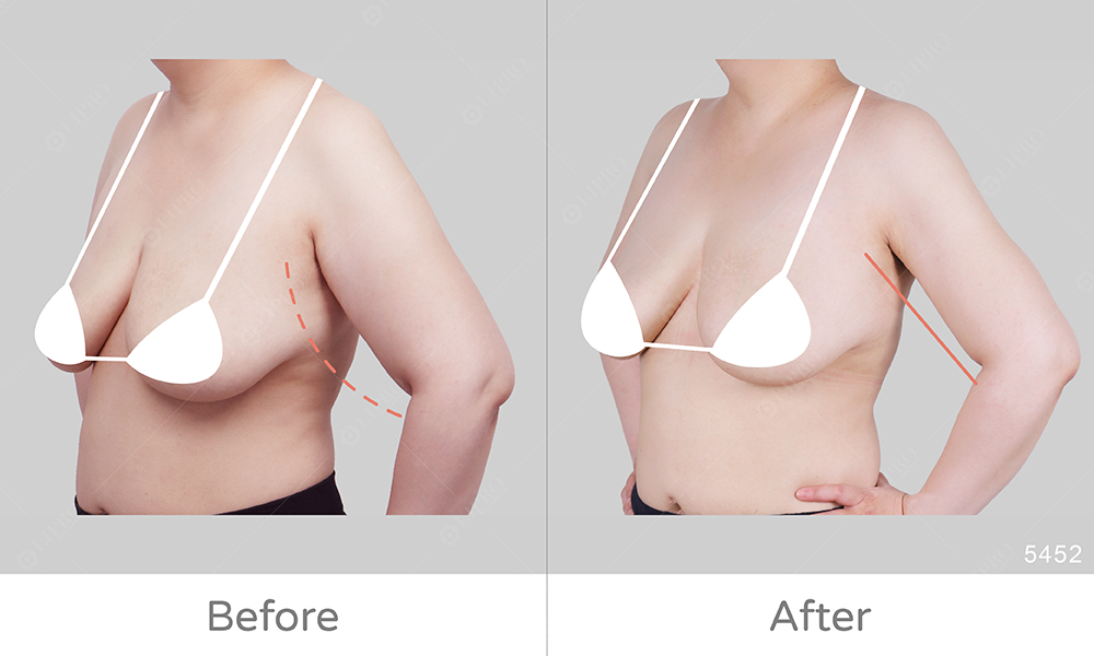 透過顯微套管精緻手臂抽脂，讓手臂上的肉肉不見了