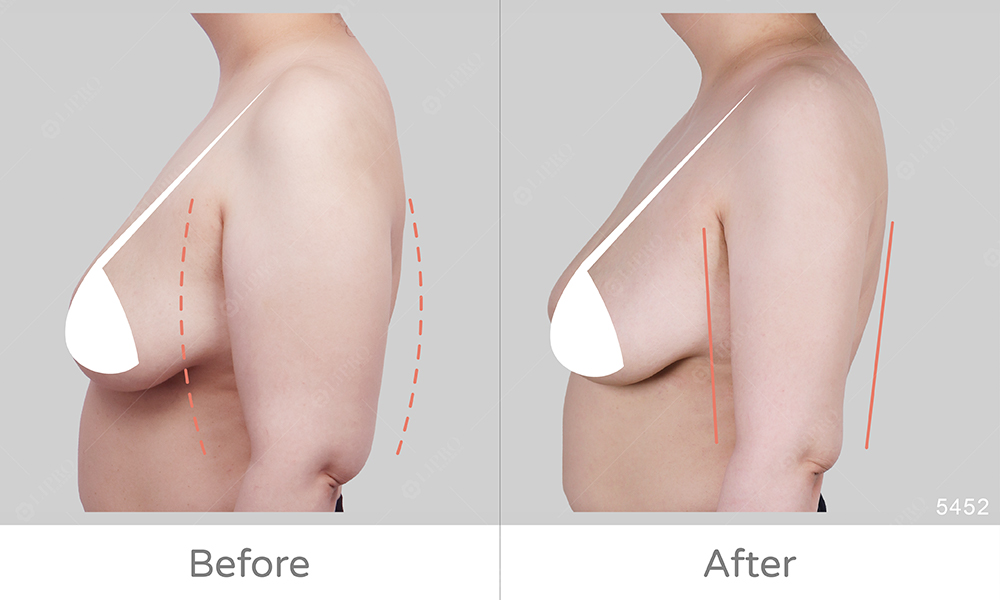 精緻手臂抽脂，顯微套管抽脂術後不需穿塑身衣、手臂線條自然平順