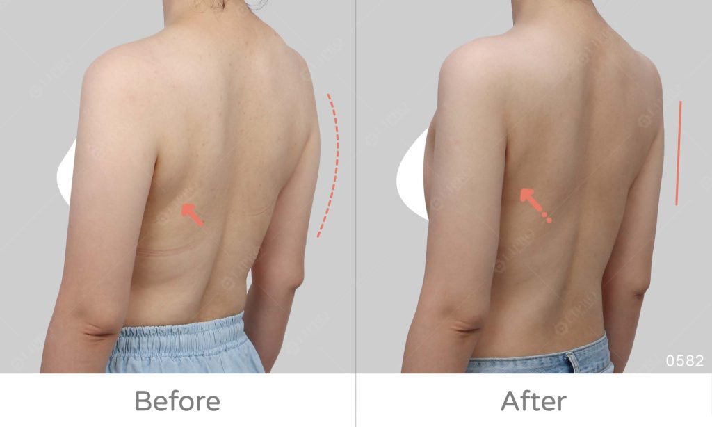 顯微套管手臂抽脂案例分析:後副乳精緻度不足、麗波永康精緻抽脂手術提升上半身美感