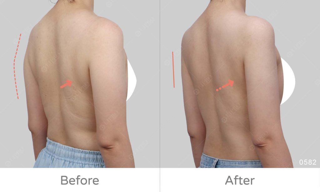 手臂精緻抽脂案例術後成果分享，顯微套管術後不需穿塑身衣