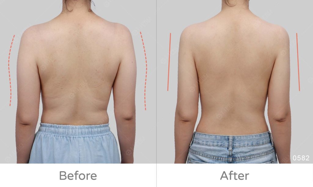 手臂抽脂案例後副乳不夠精緻，經過顯微套管抽脂處理細節達滿分