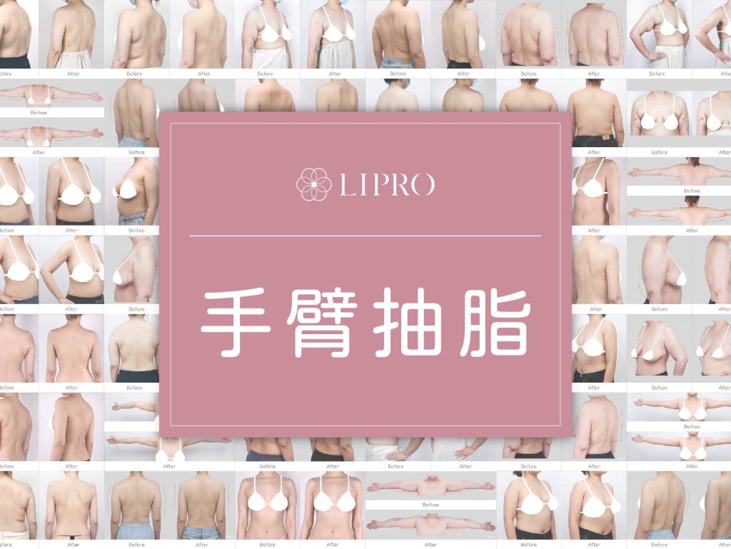 麗波永康好評、精緻抽脂手臂抽脂見證，豐富案例經驗、曲線平順自然