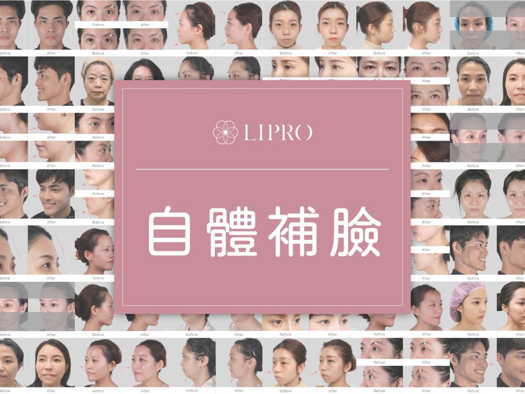 顯微套管抽脂樹feat.精微自體脂肪移植槍(MAFT GUN) ，麗波永康全臉補脂經驗豐富，困難補脂部位輕鬆掌握