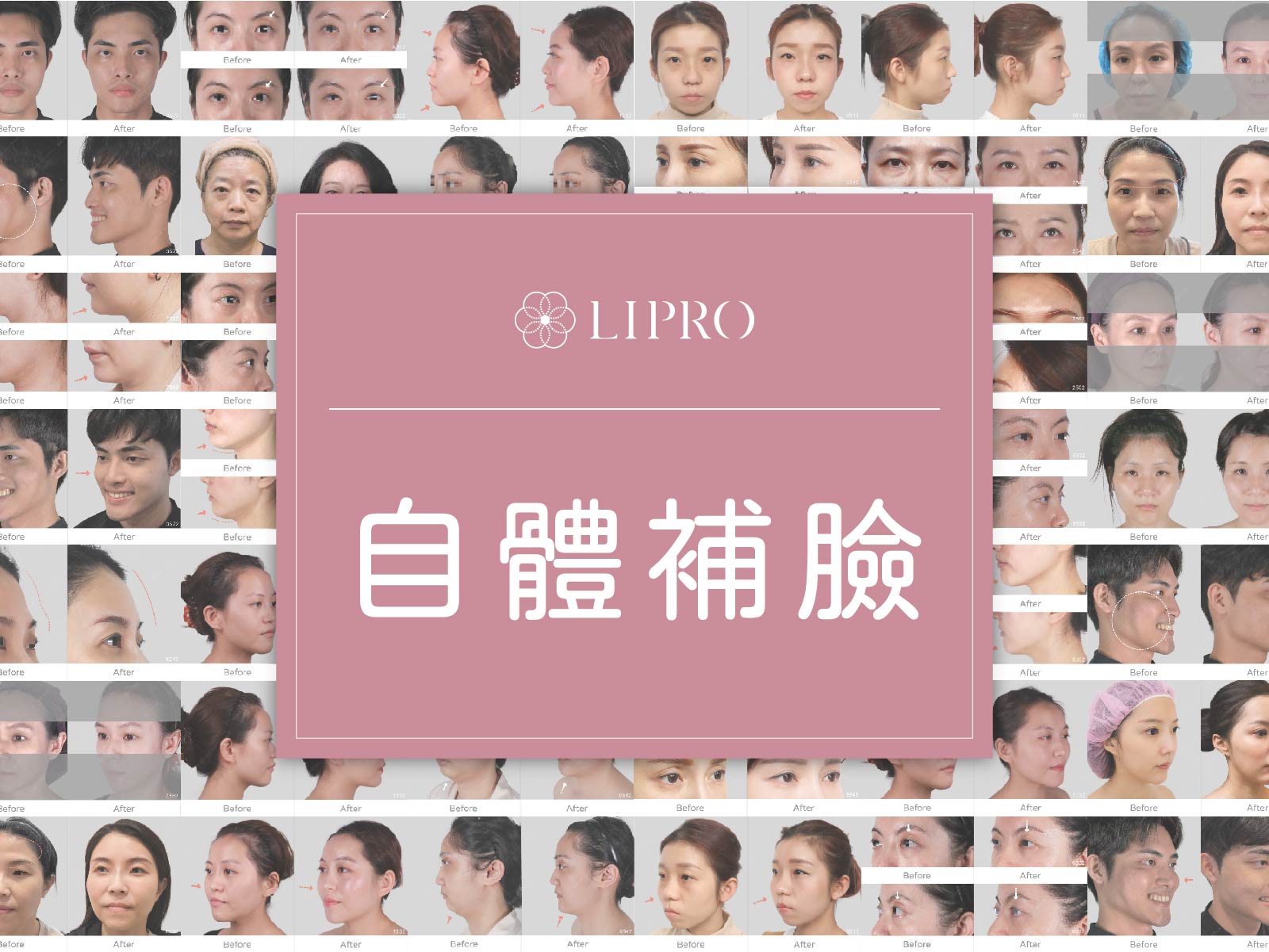 顯微套管抽脂樹feat.精微自體脂肪移植槍(MAFT GUN) ，麗波永康全臉補脂經驗豐富，困難補脂部位輕鬆掌握