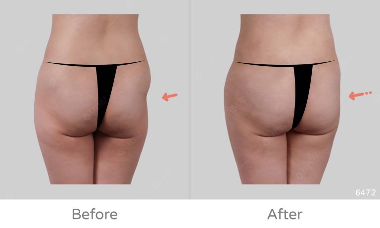 臀部凹陷處脂肪填補，顯微套管抽脂精緻填補腿凹陷處