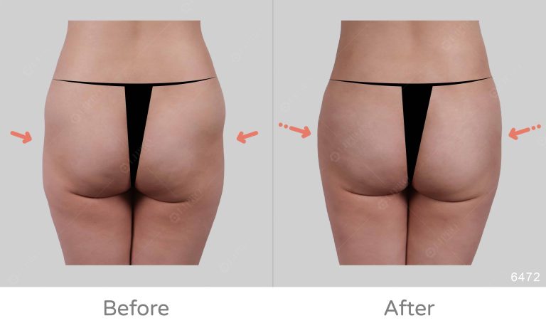 顯微套管臀部補脂案例分享，補臀成效真實呈現