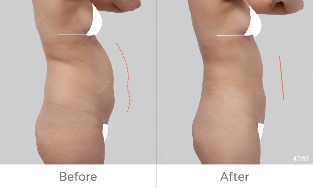 麗波永康國際診所腹部抽脂案例分享，術後不需穿塑身衣