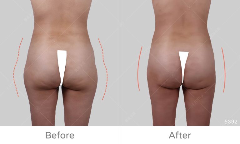 臀部曲線細緻調整，顯微套管抽脂術後不需穿塑身衣