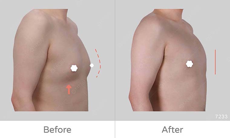 男性女乳症手術前後對比圖，側右邊面45度角展示術後成效