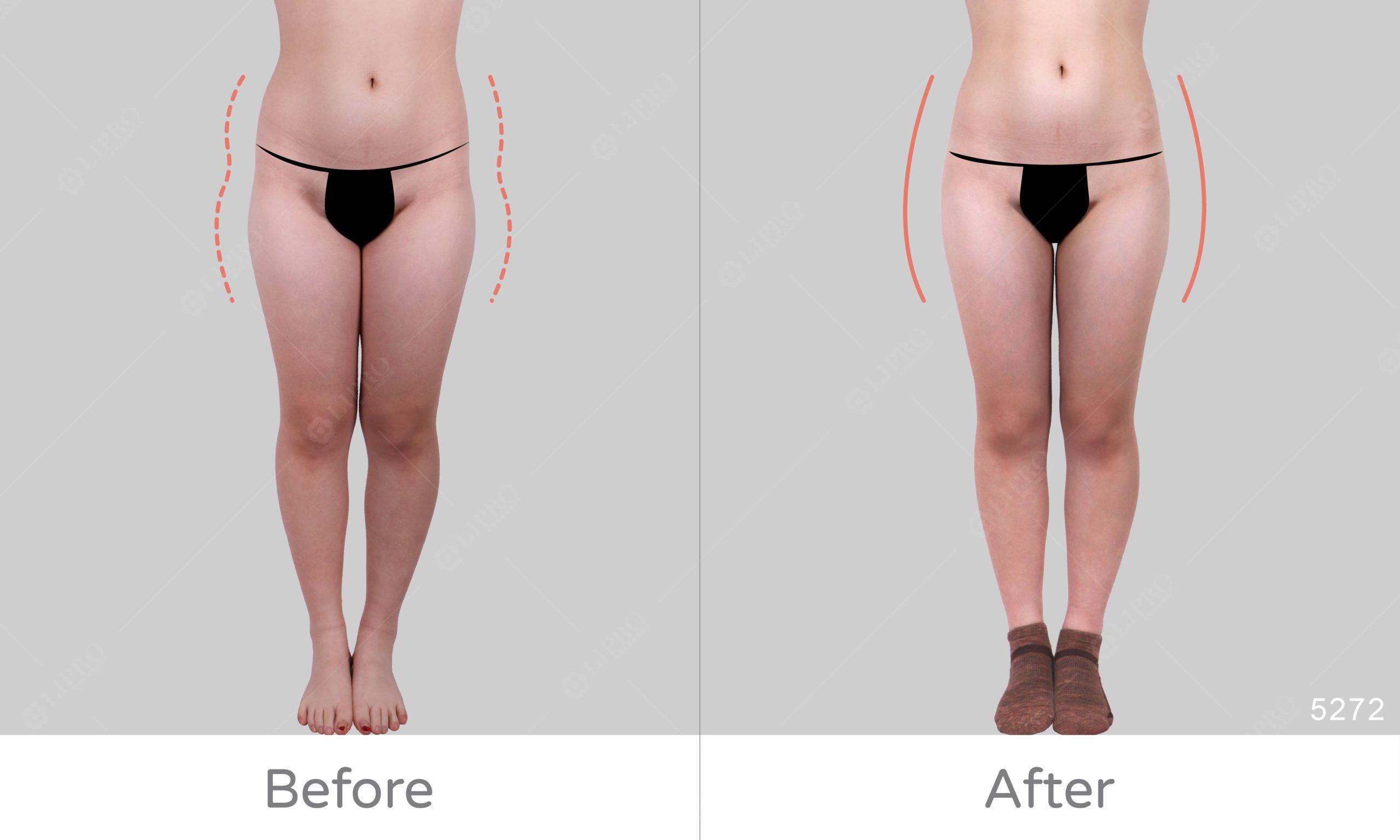 顯微套管補臀手術。先天性臀部凹陷困擾，可利用自體脂肪填補