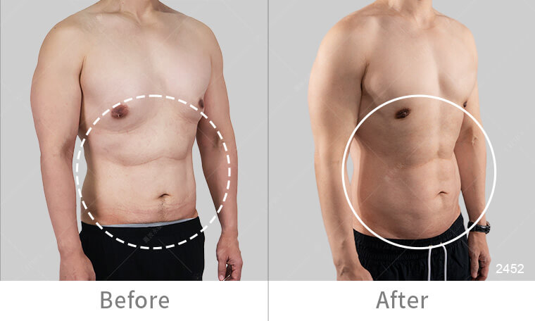 抽脂手術雕塑自然腹肌線條