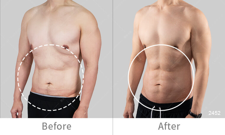 麗波永康國際診所男性腹肌雕塑手術成果