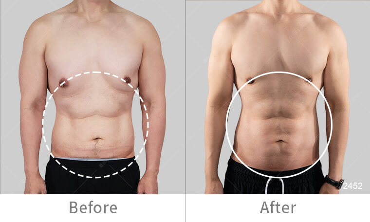 顯微套管抽脂手術幫你擁有自然腹肌