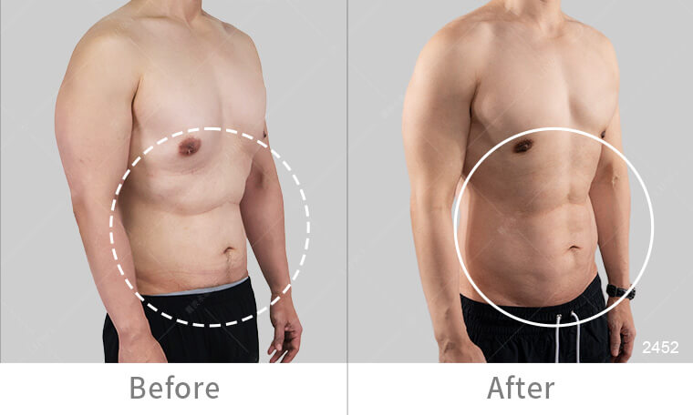 男性腹肌雕塑抽脂手術，打造自然曲線