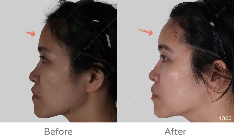 麗波永康顯微套管抽脂專家，前額美學案例，擁有飽滿前庭