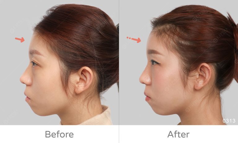 擁有飽滿前庭，前額美學的要點一次懂，額頭補脂案例分享