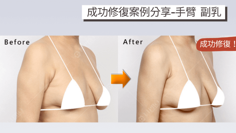 個案分享手臂及副乳部位因抽脂失敗導致皮膚呈現凹凸不平的不自然曲線
