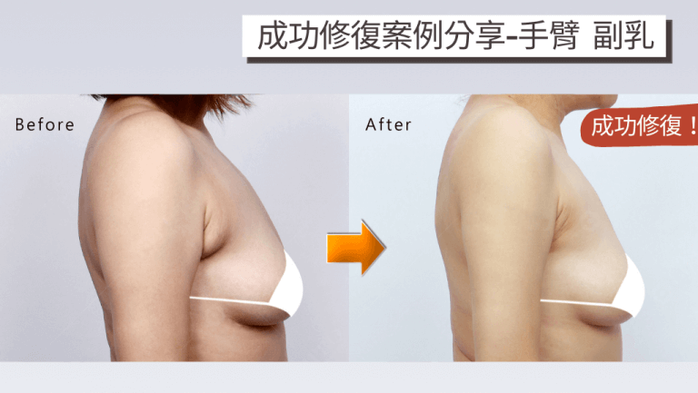 抽脂失敗後的疤痕組織處理考驗醫師技術，副乳、手臂抽脂重修案例成效分享