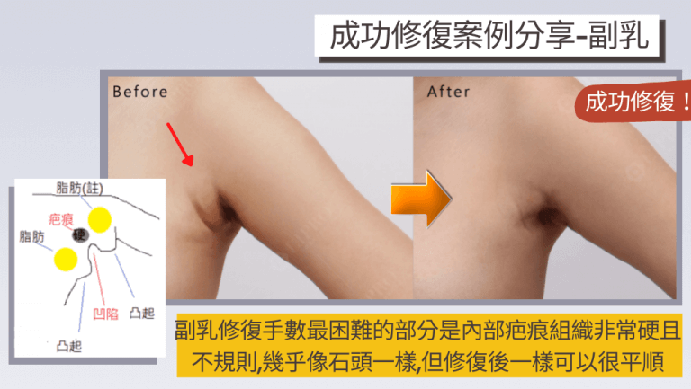 抽脂失敗後修復最困難的是疤痕組織的處理，以此副乳二次重修抽脂個案為例