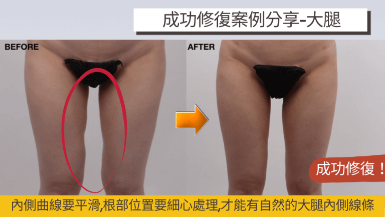 腿部抽脂成功關鍵2.內側曲線要平滑，大腿內側凹凸修復案例參考圖片
