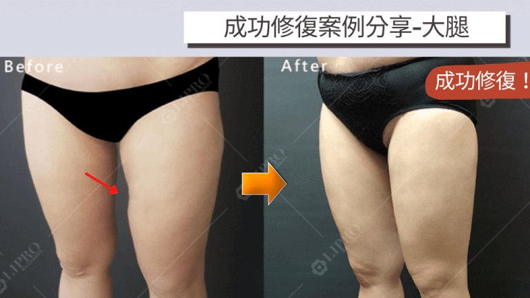 抽取大腿脂肪豐臉，卻在腿部留下了明顯凹陷，經二次手術修復成效對比