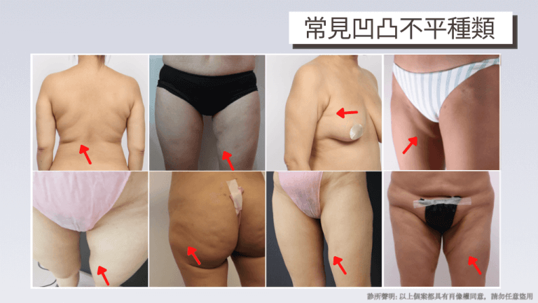 抽脂後遺症該怎麼辦、抽脂失敗的凹凸不平案例參考圖
